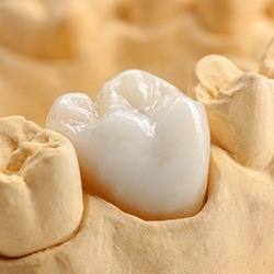 Model smile with tooth-colored dental crown restoration