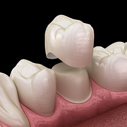 3D illustration Dental crowns in Sweeny 