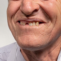 Man missing multiple teeth