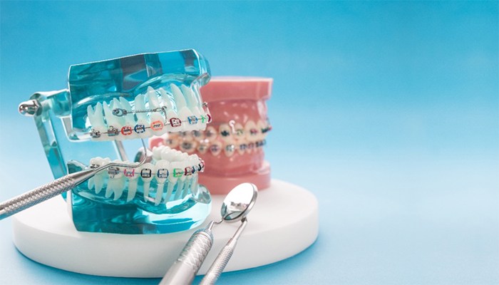 model of braces
