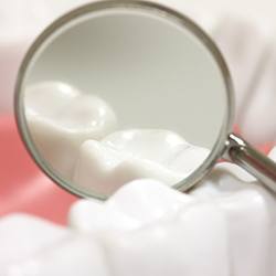 Closeup of teeth with dental sealants