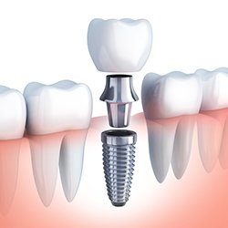 Animation of implant dental crown placement