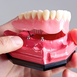 Model of implant supported denture