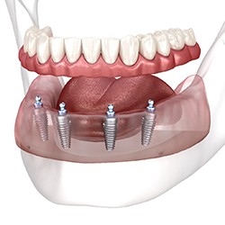 Digital image of an implant denture