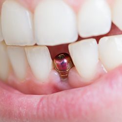 An up-close image of a dental implant situated on the lower arch of a person’s mouth