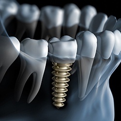 Animation of implant supported dental crown