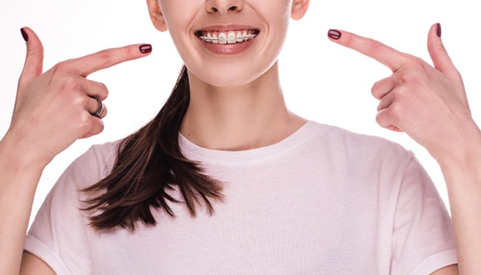 Woman pointing at her treatment for orthodontic relapse in Sweeny