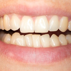 Close-up of smile with crooked teeth on bottom