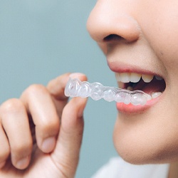 Close-up of woman inserting clear aligner into mouth
