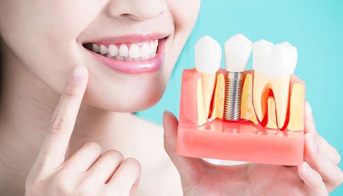 Woman pointing to her tooth and holding model of dental implants.