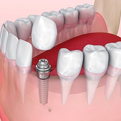 Digital model of a single dental implant.