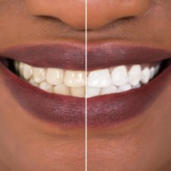 Closeup of woman's smile before and after teeth whitening