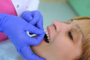 Woman getting her veneers bonded on